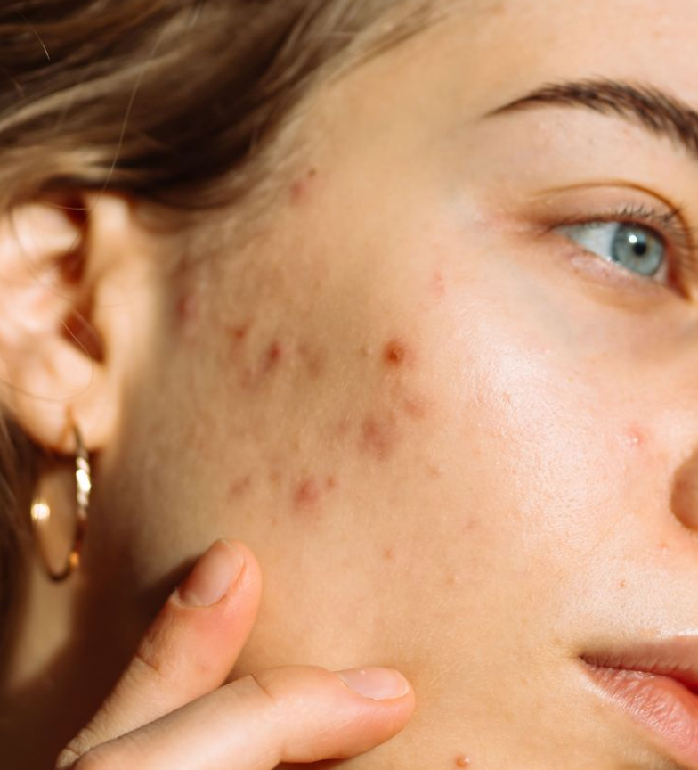 Acne