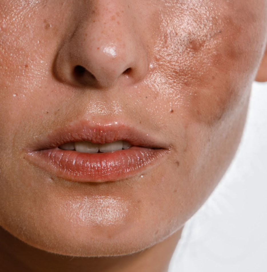 Discolouration / Hyperpigmentation